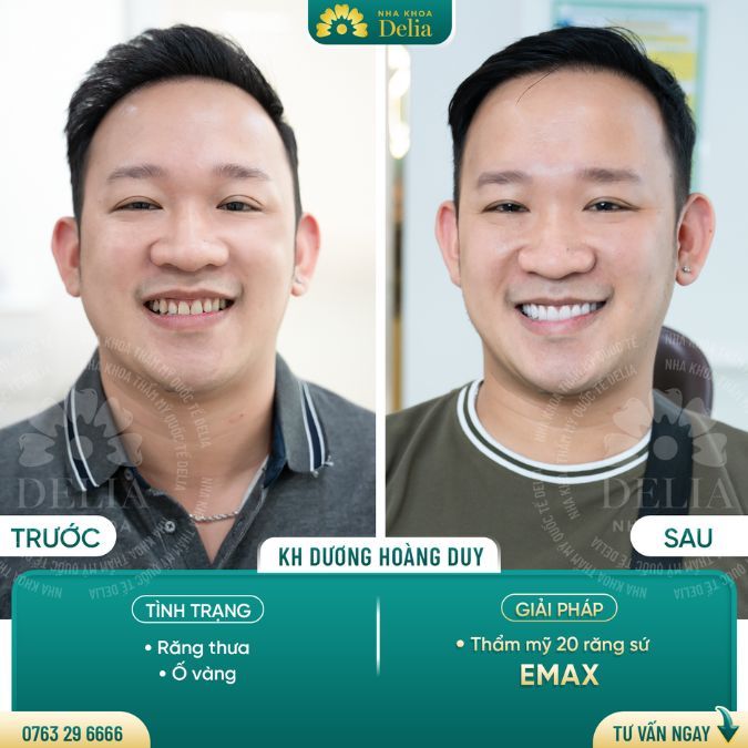 Sau khi bọc sứ, bạn sẽ thấy màu sắc răng sẽ thay đổi hoàn toàn