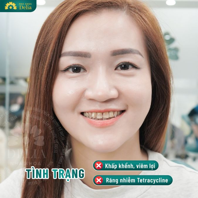 Trám răng bị mẻ mức độ nhẹ