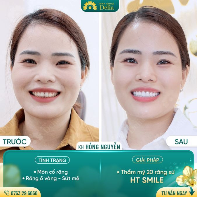 Tùy từng phương pháp, khoảng thời gian điều trị cũng sẽ khác nhau
