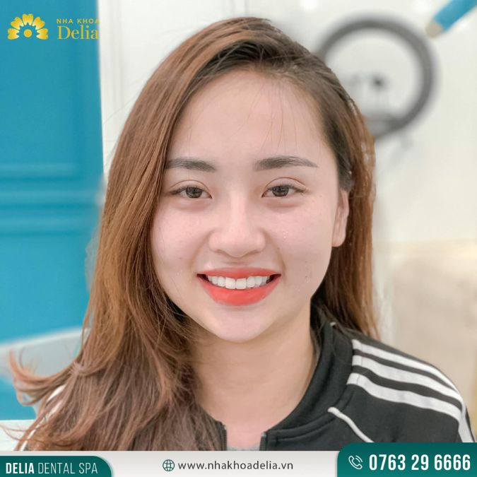 Dùng sáp nha khoa khắc phục răng bị mẻ