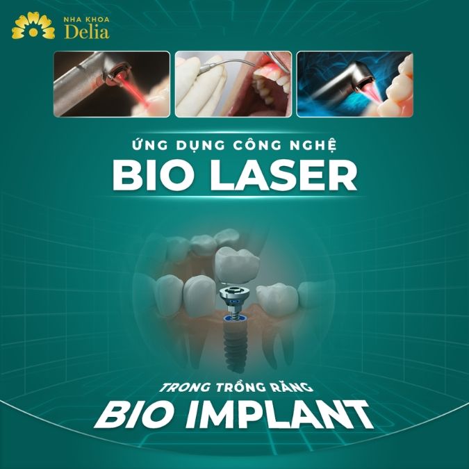 Tại sao nên cấy ghép trụ Implant tại nha khoa Delia?
