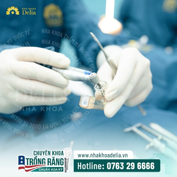 Tại sao nên cấy ghép trụ Implant tại nha khoa Delia?
