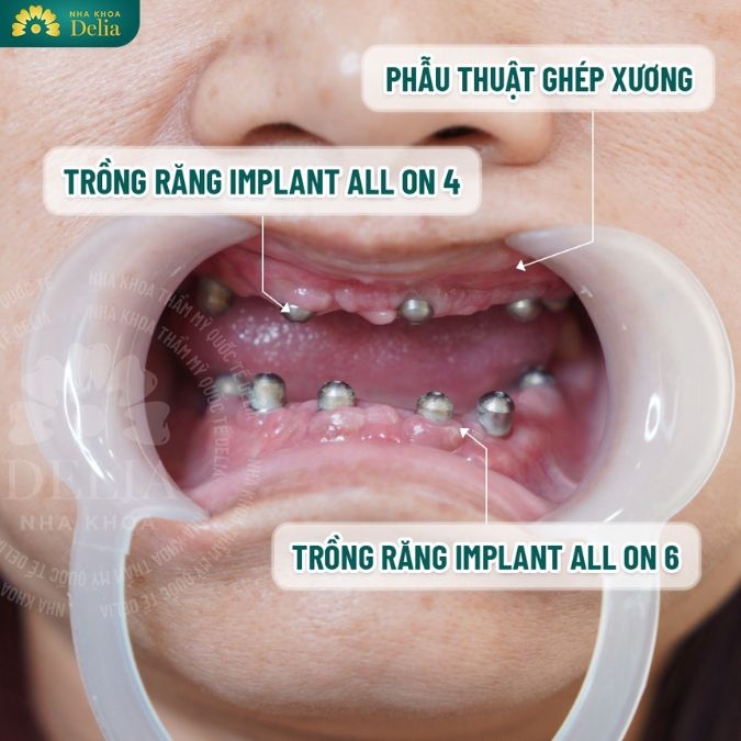 Cấy trụ Implant bao lâu thì gắn răng hoàn thiện?
