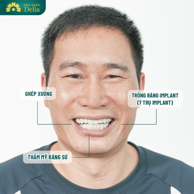 Khách hàng Lê Xuân Hùng trải nghiệm trồng 7 trụ Implant tại nha khoa Delia