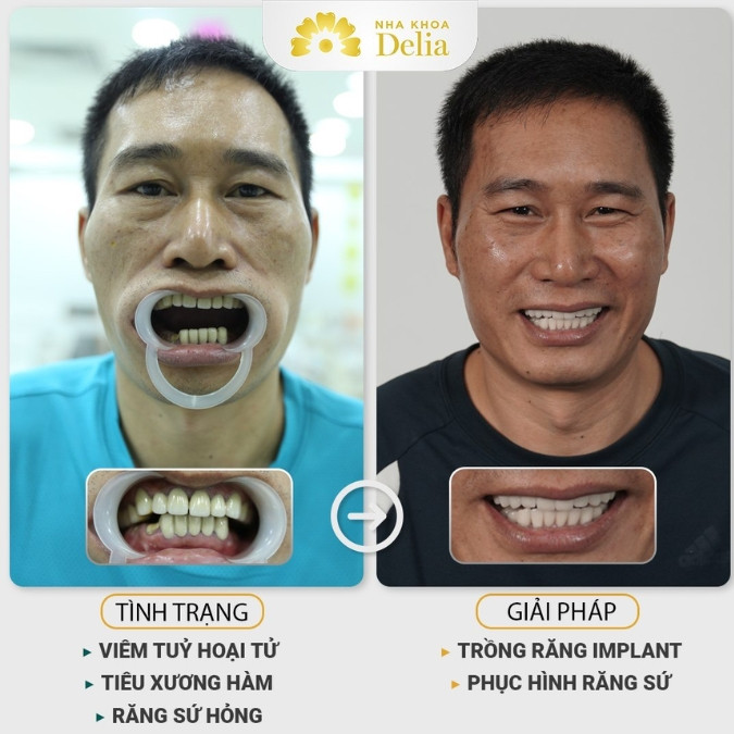 Khách hàng Lê Xuân Hùng trồng 7 trụ Implant tại nha khoa Delia