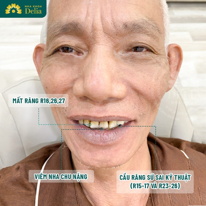 Khách hàng Nguyễn Văn Năm trải nghiệm trồng 9 trụ Implant tại nha khoa Delia 