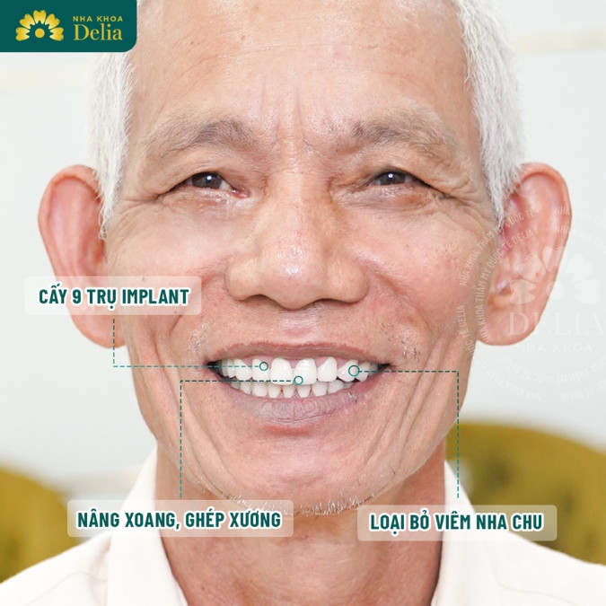 Khách hàng Nguyễn Văn Năm trải nghiệm trồng 9 trụ Implant tại nha khoa Delia 