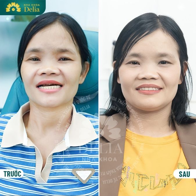 Case thực tế các khách hàng trồng răng thành công tại Delia