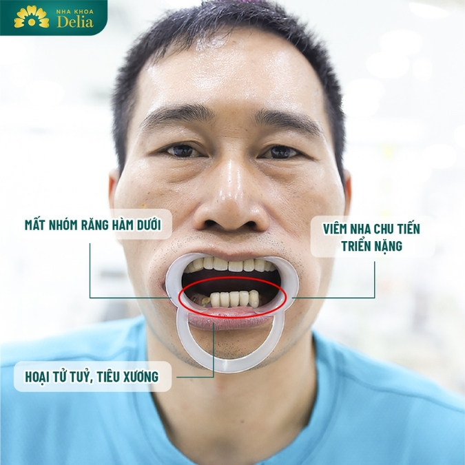 Anh Tuấn đã có thể thoải mái ăn những món ăn yêu thích