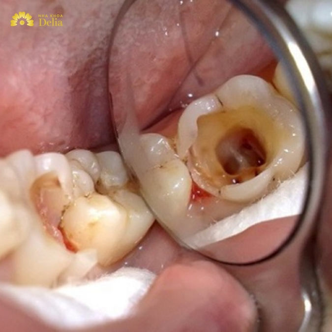 Các trường hợp không nên trồng Implant