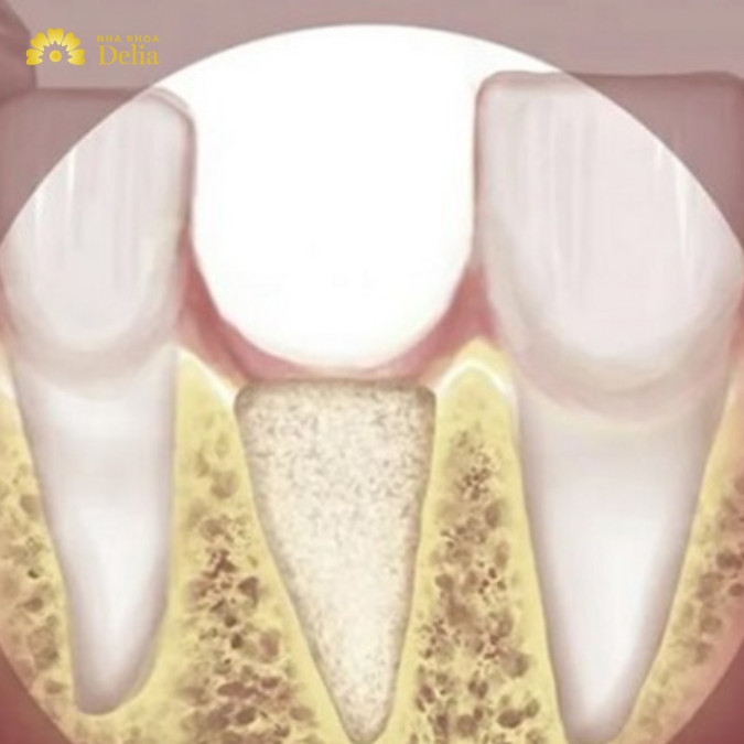 Chỉ còn chân răng không phục hình có sao không?