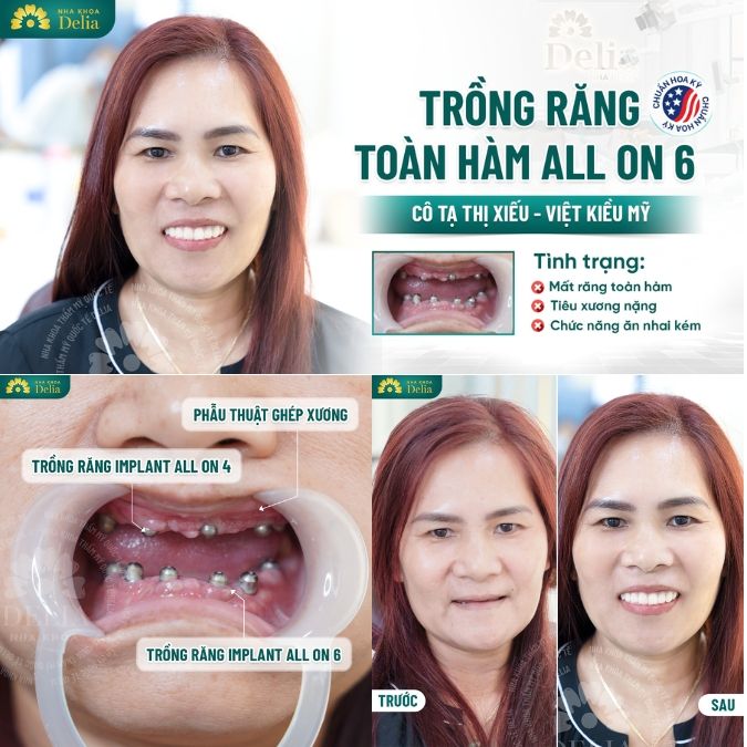 Các case khách hàng thành công sử dụng công nghệ Bio Implant