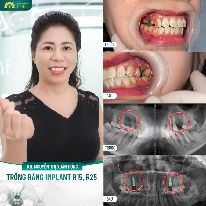 Các case khách hàng thành công sử dụng công nghệ Bio Implant