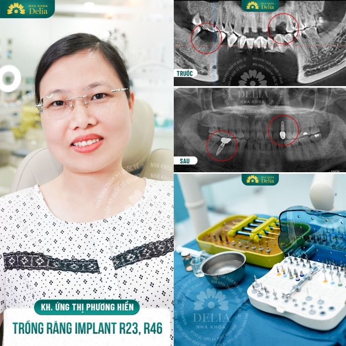 Các case khách hàng thành công sử dụng công nghệ Bio Implant