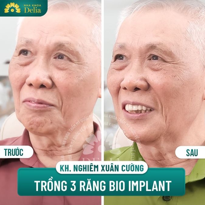 Công nghệ Bio Implant sử dụng cho ai?