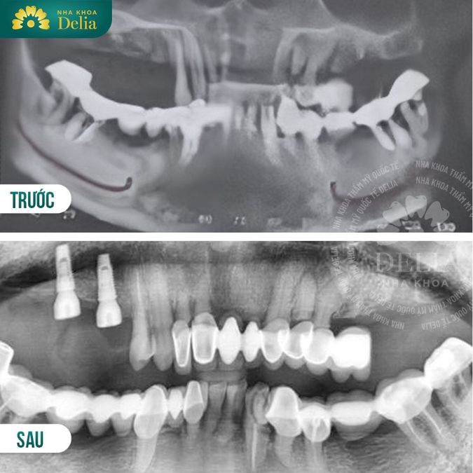 Quy trình trồng răng Bio Implant