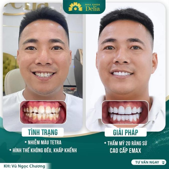 Anh Chương tự tin hơn khi cười sau khi bọc sứ