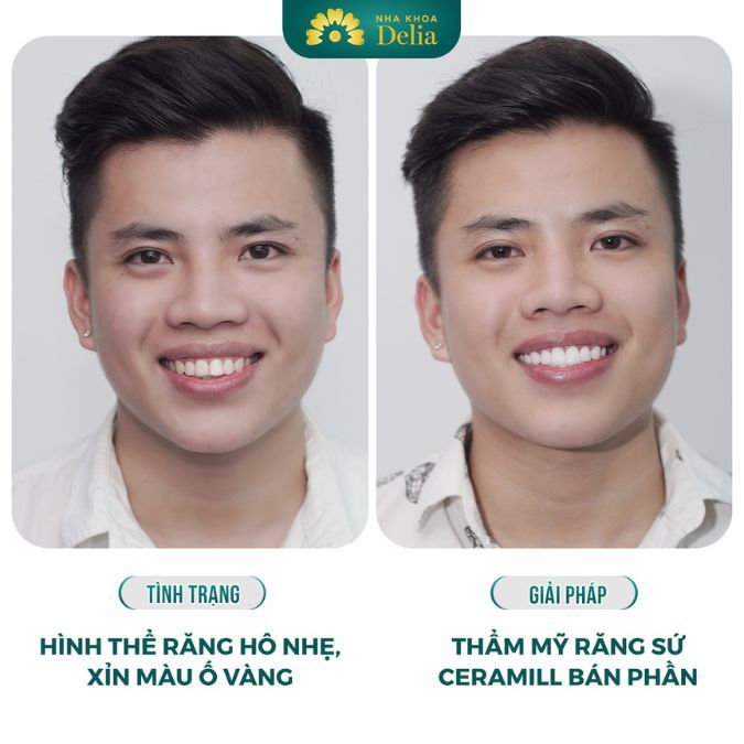 Trước và sau khi làm răng sứ tại Delia