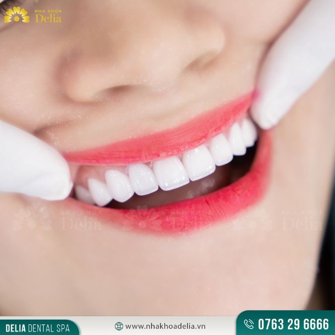 Mặt dán sứ Veneer Lisi Press
