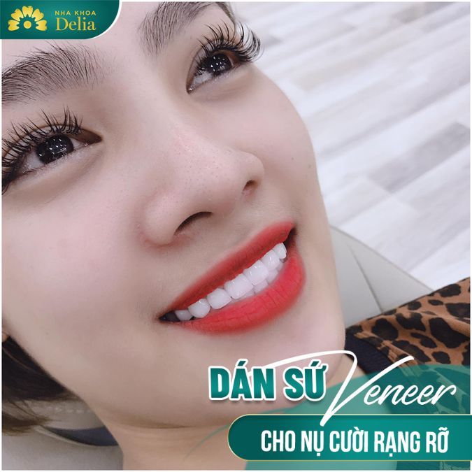 Thực chất dán sứ Veneer sẽ không ảnh hưởng tới cấu trúc men răng