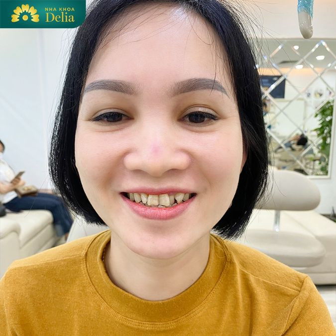 The risk of porcelain teeth being easily broken, cracked, or broken