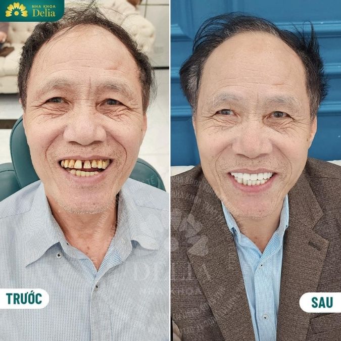 Hình ảnh khách hàng trồng răng tại nha khoa Delia 
