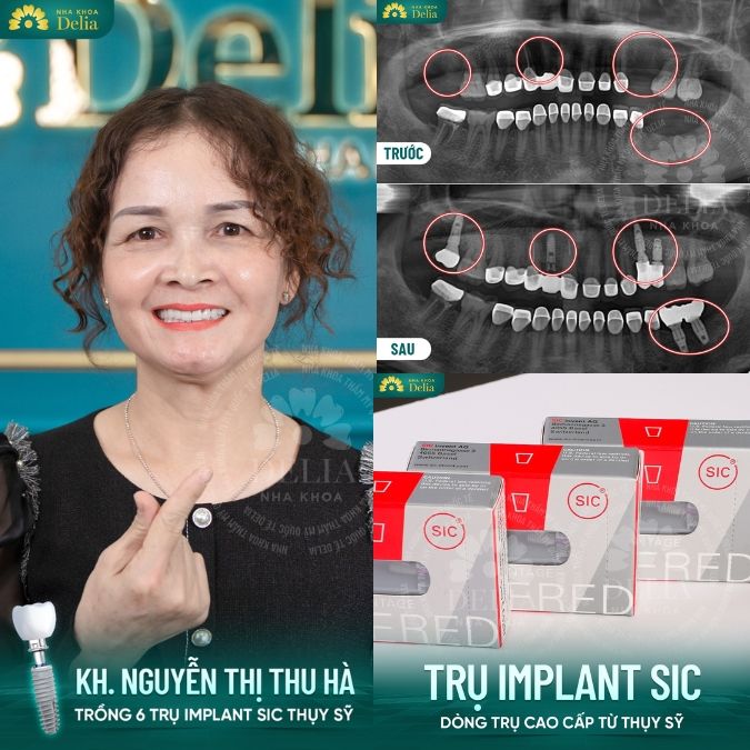 Hình ảnh khách hàng trồng răng tại nha khoa Delia 