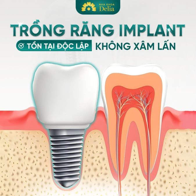 Trồng Implant có thể khôi phục chức năng ăn nhai hiệu quả 