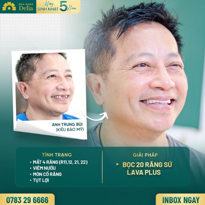 Phương pháp trồng răng Implant có gì nổi bật? 
