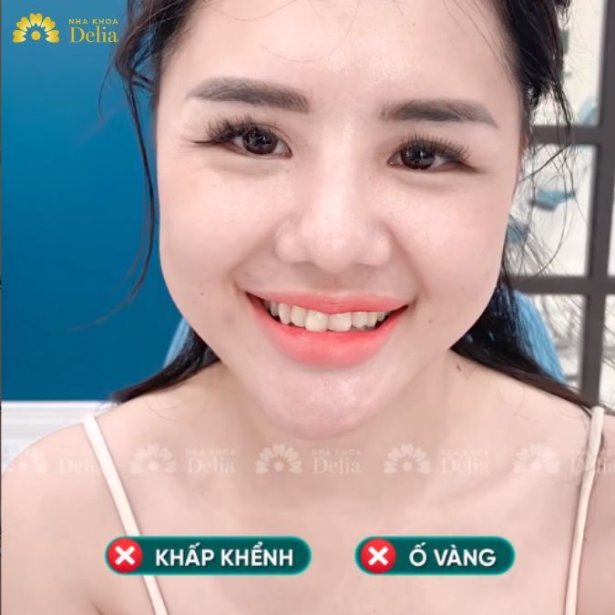 Dẫu sở hữu một gương mặt xinh đẹp, khả ái nhưng chị Hương vẫn mong muốn cải thiện hàm răng khiếm khuyết của bản thân