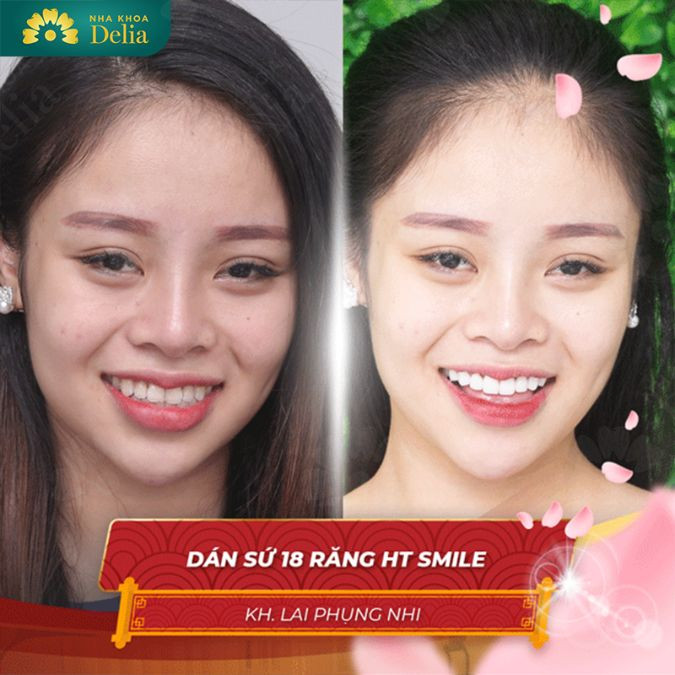 Chị Phụng Nhi dán 18 răng sứ HT Smile