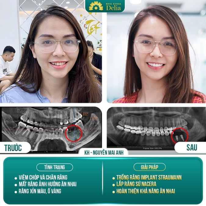 Hình ảnh trồng răng Implant