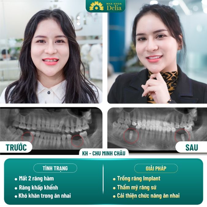 Hình ảnh trồng răng Implant