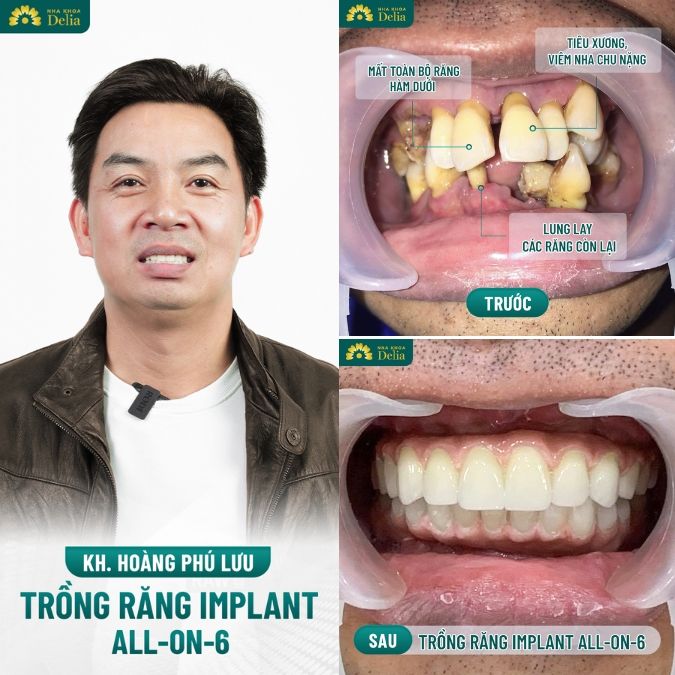 Hình ảnh trồng răng Implant