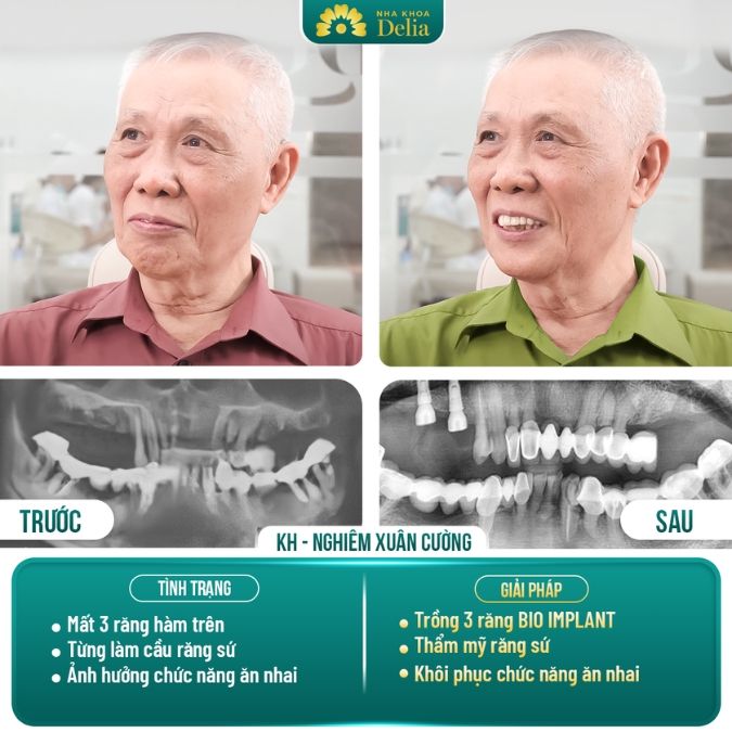 Hình ảnh trồng răng Implant