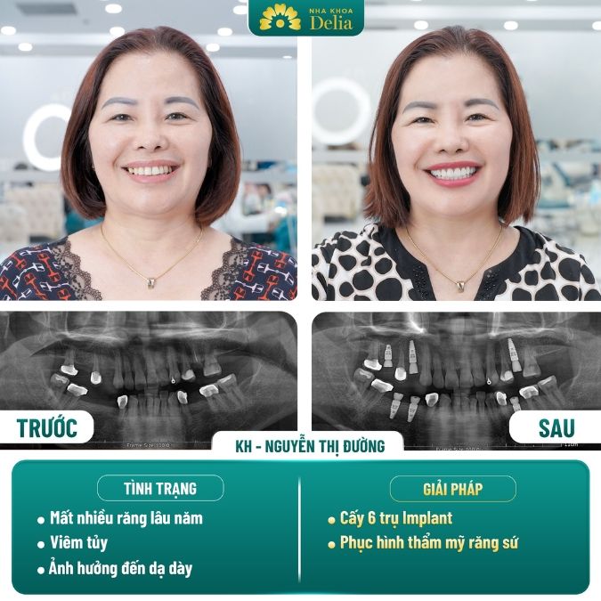 Hình ảnh trồng răng Implant