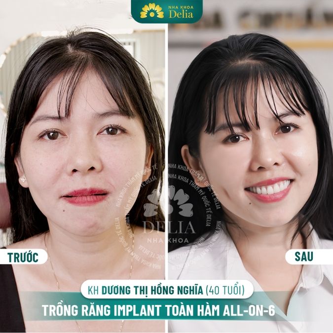 Hình ảnh trồng răng Implant