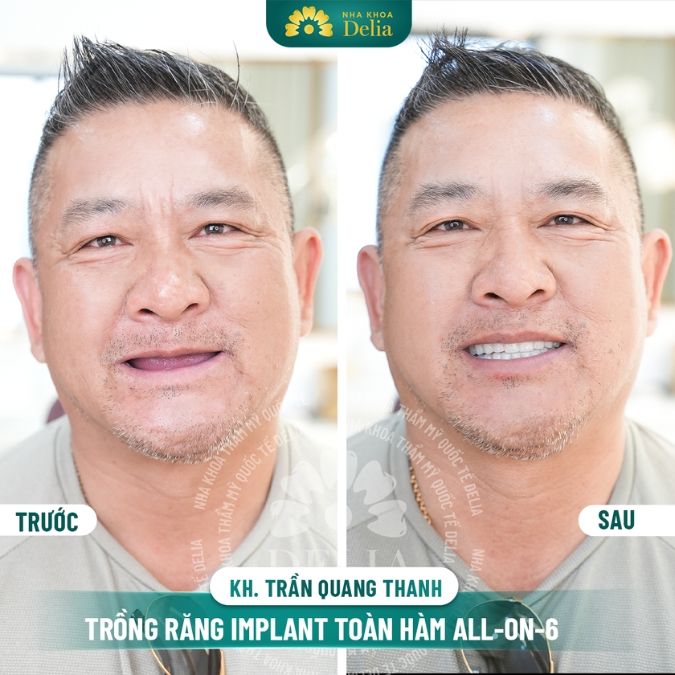 Hình ảnh trồng răng Implant
