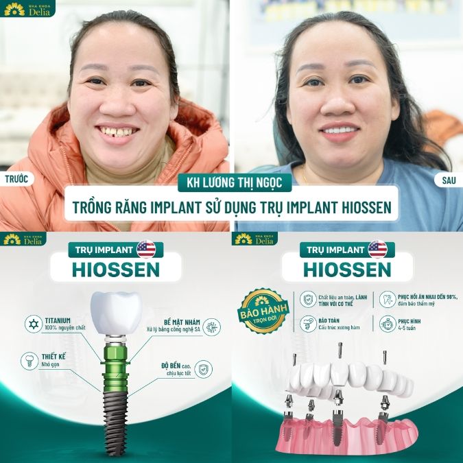 Hình ảnh trồng răng Implant