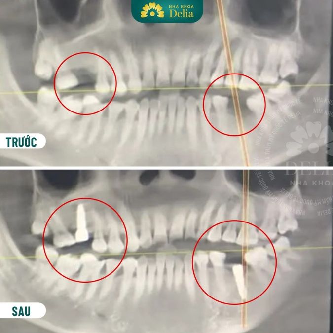 Điều kiện tiên quyết để một ca trồng Implant thành công là gì?