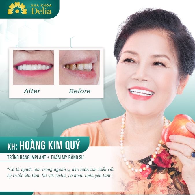 Hình ảnh trồng răng Implant