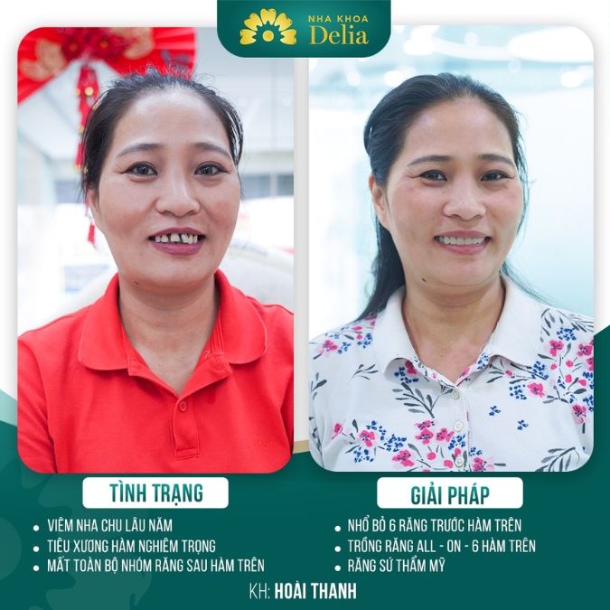 Hình ảnh trồng răng Implant