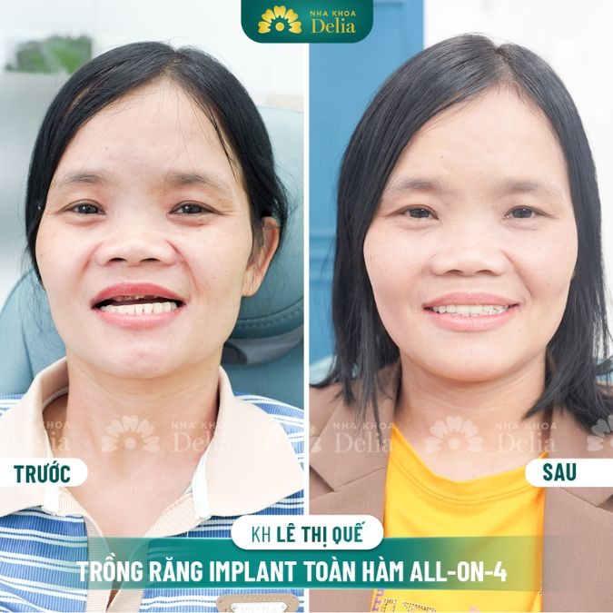 Hình ảnh trồng răng Implant