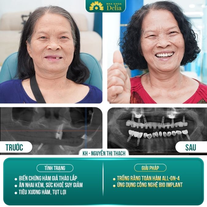 Hình ảnh trồng răng Implant