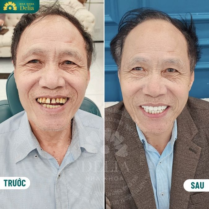 Khi nào nên trồng răng Implant? Tại sao nên trồng Implant sớm?