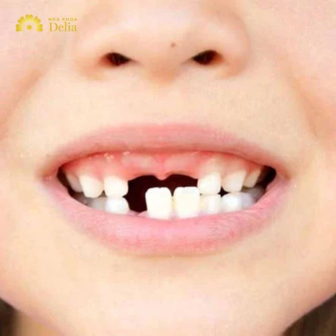 Trồng răng Implant không ứng dụng cho các trường hợp nào?