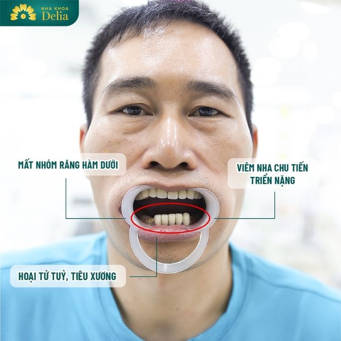 Mất chân răng có trồng được không?