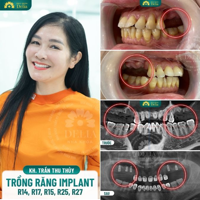 Ưu điểm nổi bật của phương pháp trồng răng Implant
