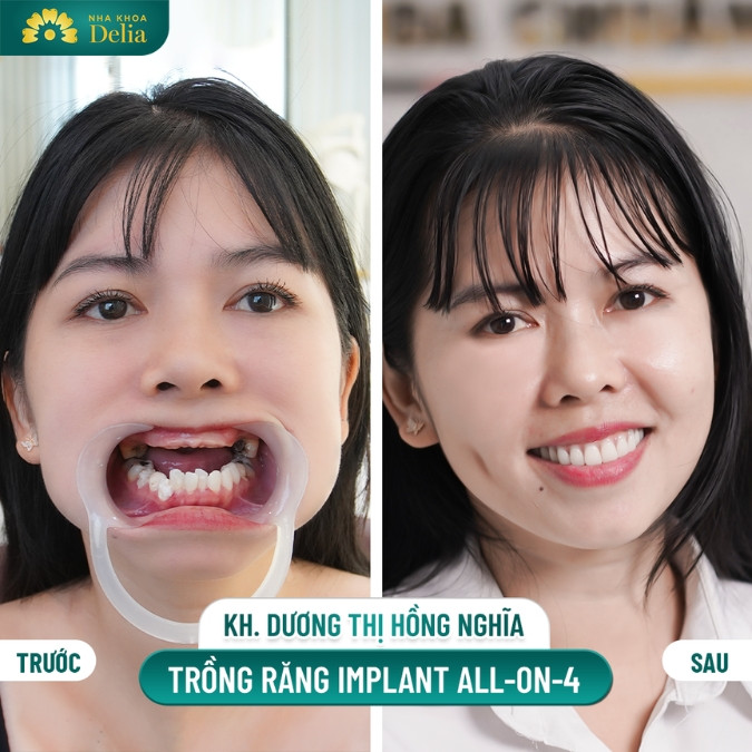 Nên cấy ghép Implant vào thời điểm nào tốt nhất?
