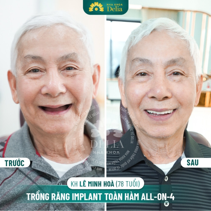 Nên cấy ghép Implant vào thời điểm nào tốt nhất?